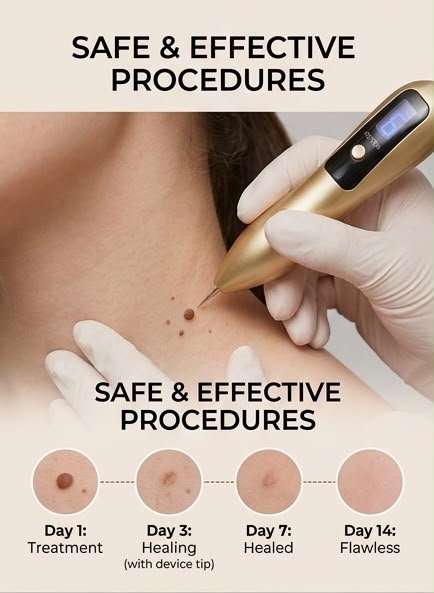 Cleura Mole and Wart Removal Pen